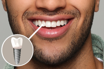 A photo highlighting a bearded man’s front-facing dental implant