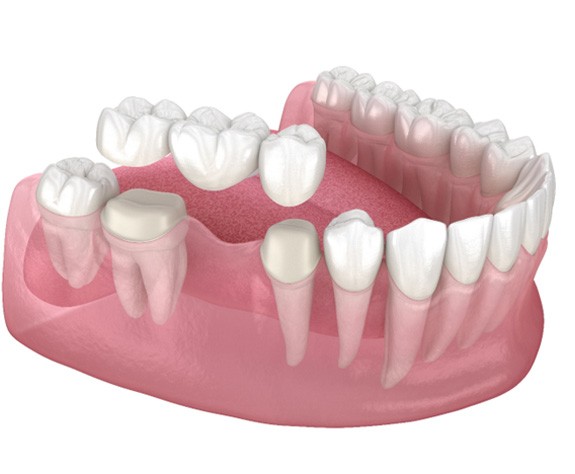 animated depiction of a dental bridge 