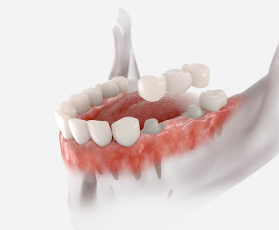 animated image of a traditional dental bridge 