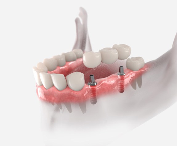 animated image of a traditional dental bridge