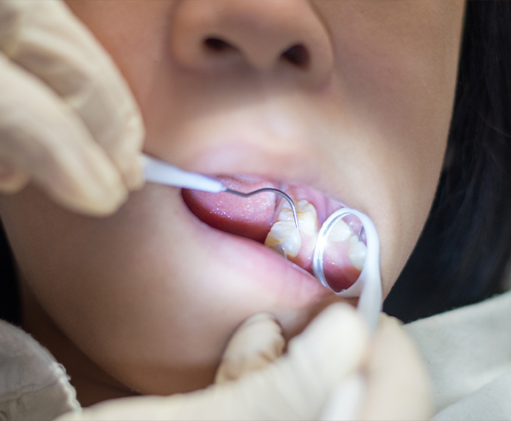 Children's dentist examining smile after placing dental sealants