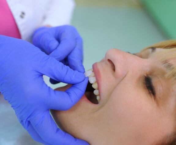 Dentist comparing cosmetic dental bonding color option to smile