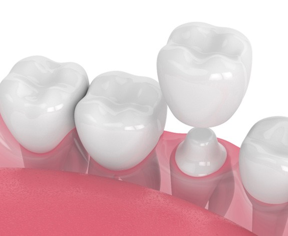 animated depiction of dental crown 