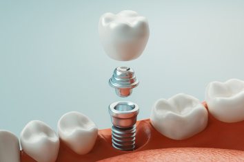 Illustration of the parts of a dental implant