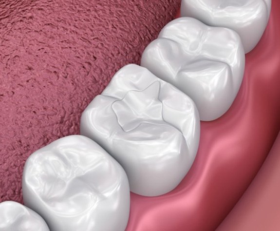 3 D illustration of a tooth colored filling