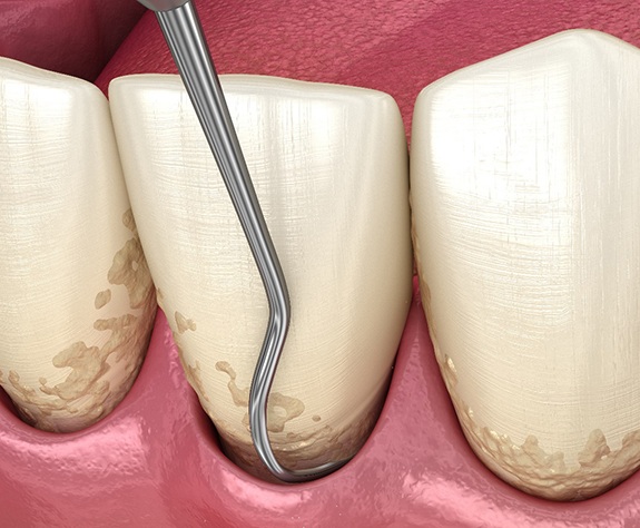 Man leaning back in dental chair and smiling