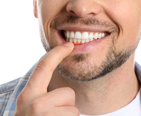 Man pulling down his lip to show his gums