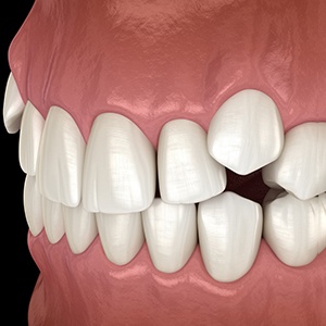 Illustration of crowded, overlapping teeth