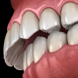 Illustration of overbite against dark background