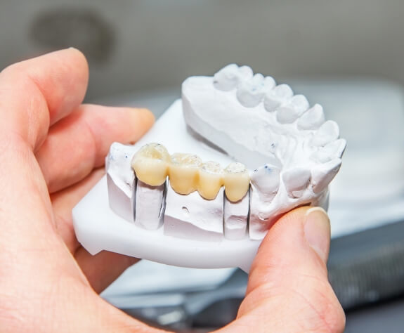 Model smile with dental bridge restoration