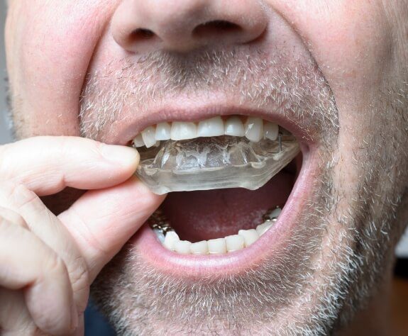 Closeup of dental patient placing a nightguard for bruxism