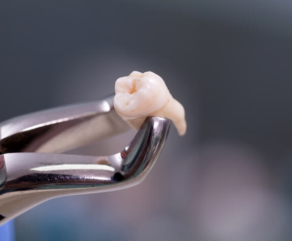 Metal clasp holding a tooth after extraction