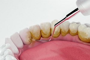 a 3 D illustration of scaling and root planing