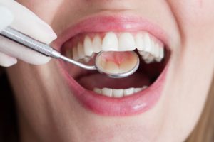 Gloved hand holding dental mirror in patient’s mouth