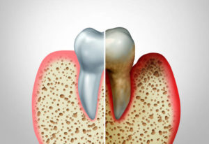 Comparison of health and unhealthy gums